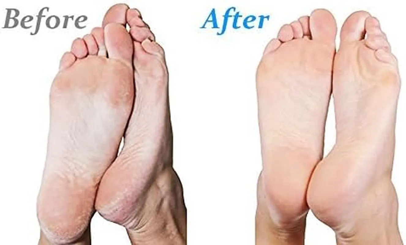 Micro-Pedi 3D POWER Callus Remover with Xtreme Coarse Soft & Flexible Roller (Most Powerful & Corded)